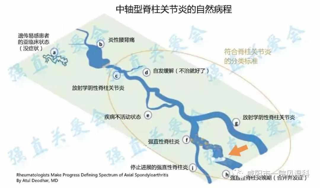 咸阳市第一人民医院："不死的癌症"——强直性脊柱炎20年抗争记