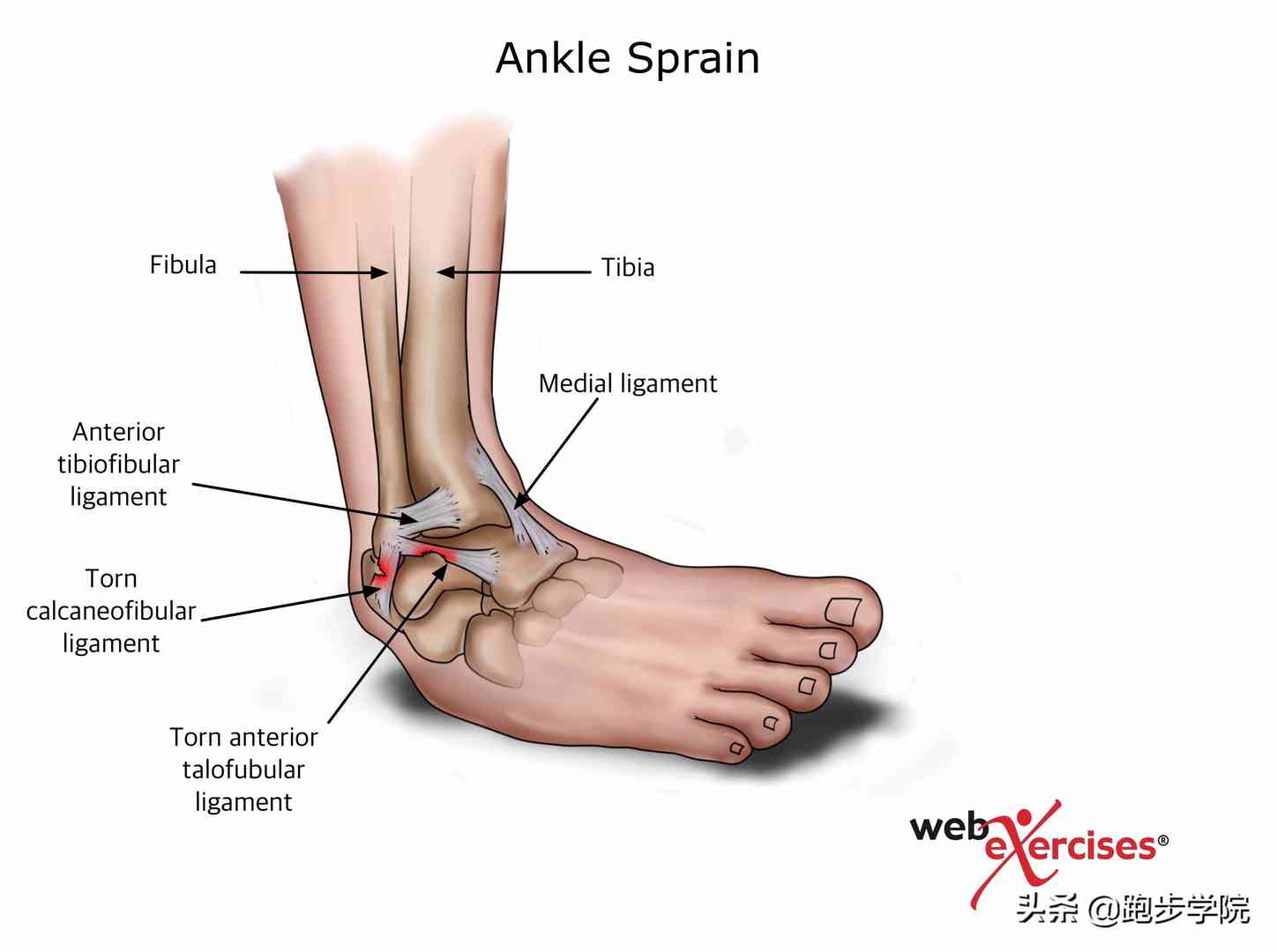 关于脚踝扭伤的所有干货，都在这了