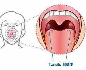 孩子扁桃体发炎怎么办？到底要不要切？