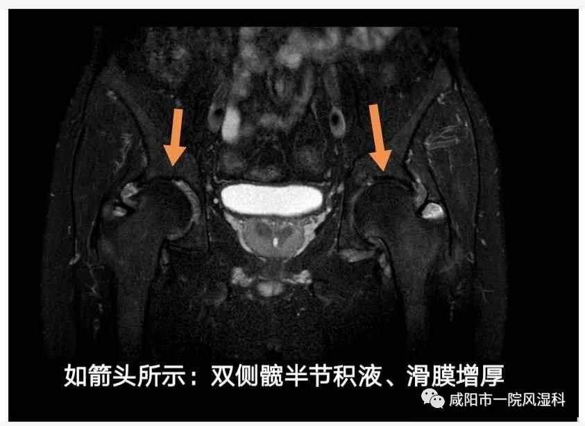 咸阳市第一人民医院："不死的癌症"——强直性脊柱炎20年抗争记