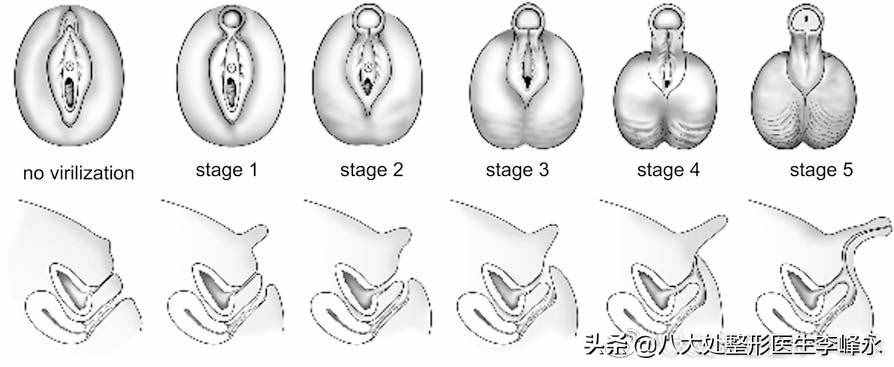 性发育异常（两性畸形），你该知道的事情