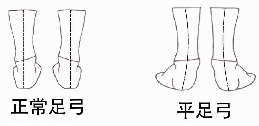 扁平足——有一种痛叫做“脚踏实地”的痛