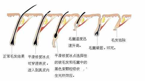 冰点脱毛原理图解