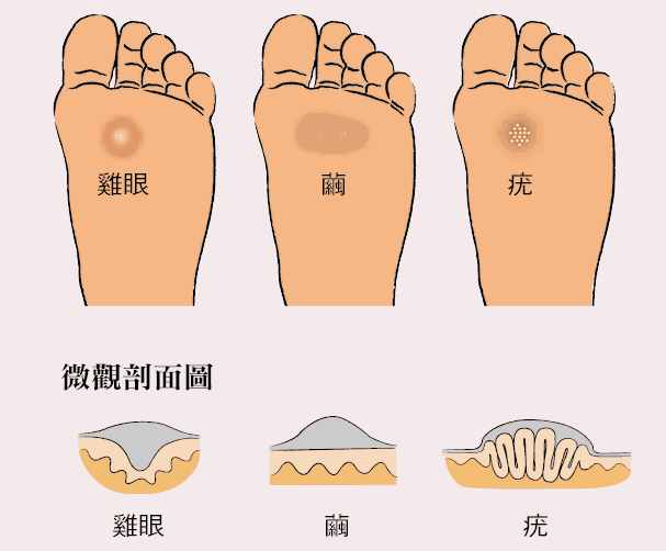 痛痛痛！脚底长了鸡眼怎么办，挖掉会再长吗？医生告诉你怎么做