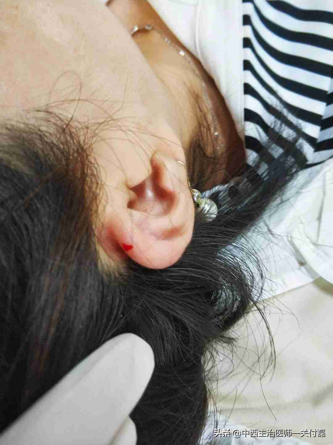 发烧、热毒、皮肤疮痒，中医有个简单有效的耳尖刺血疗法