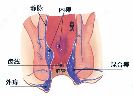 痔疮久治不愈？是你没用对药，肛肠科医生列出「详细用药攻略」