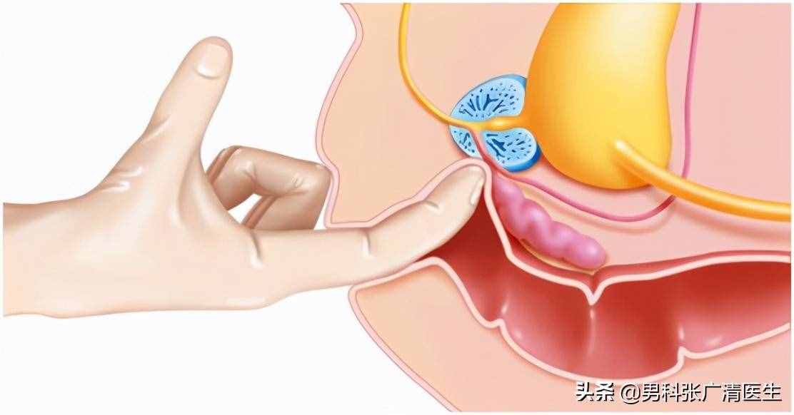 前列腺的“爆菊花”指检法