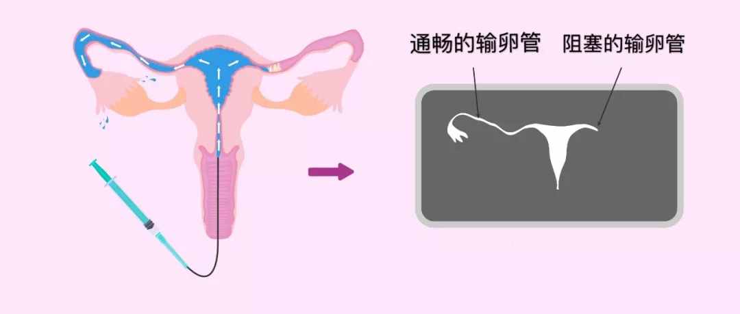 输卵管造影的5个步骤