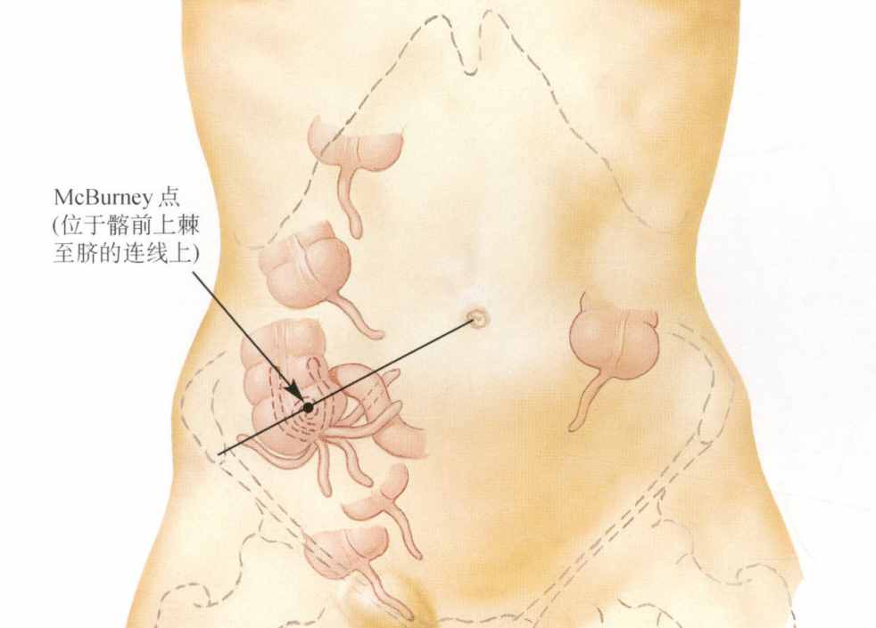 科普阑尾炎症状及特点，怎么预防和治疗阑尾炎