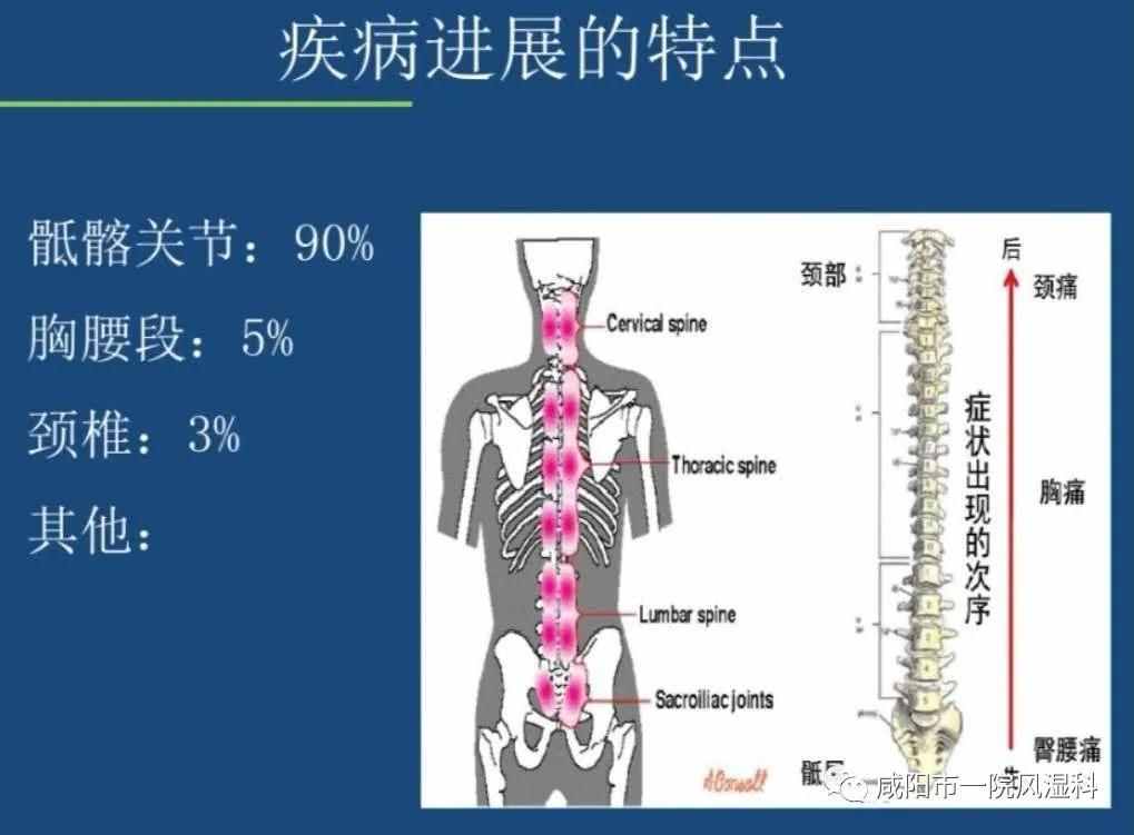 咸阳市第一人民医院："不死的癌症"——强直性脊柱炎20年抗争记