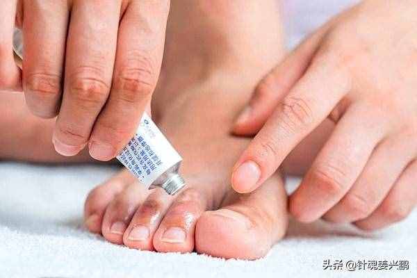 “脚气”真菌怎么才能根治？3个人人实用的方法，彻底治好不复发