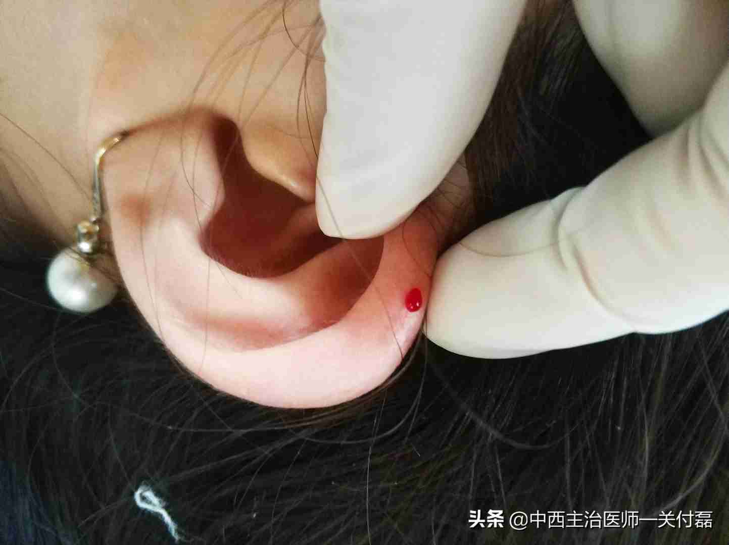 发烧、热毒、皮肤疮痒，中医有个简单有效的耳尖刺血疗法