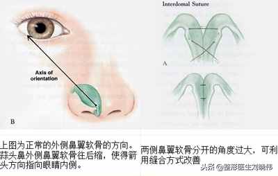 有什么好办法能让大鼻头变小？