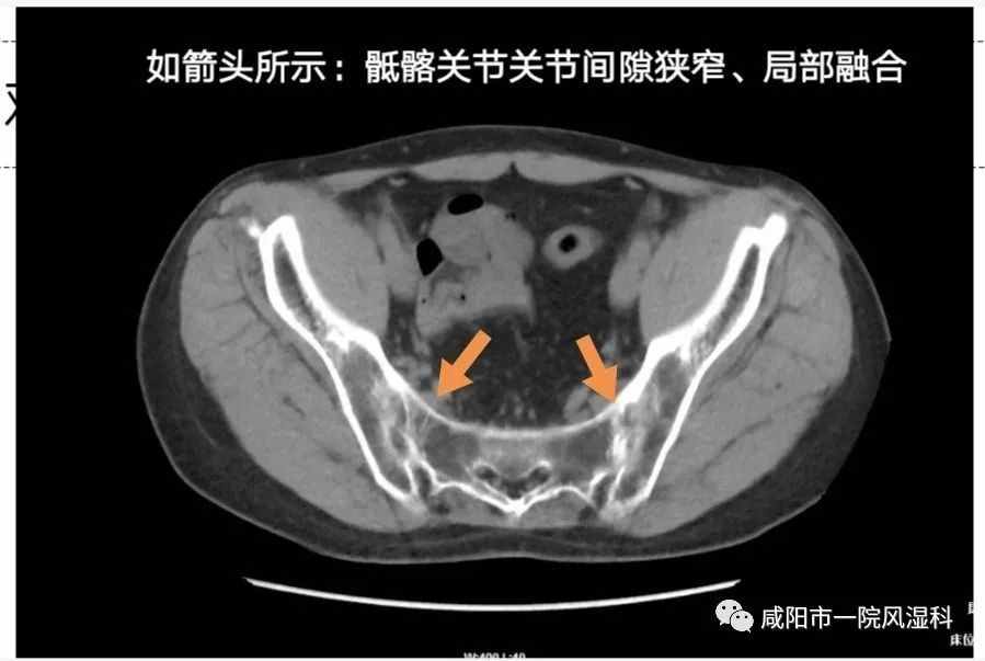 咸阳市第一人民医院："不死的癌症"——强直性脊柱炎20年抗争记